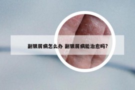 副银屑病怎么办 副银屑病能治愈吗?