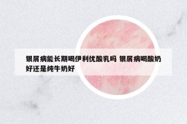 银屑病能长期喝伊利优酸乳吗 银屑病喝酸奶好还是纯牛奶好