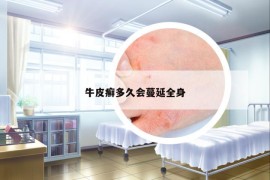 牛皮癣多久会蔓延全身