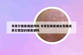 寻常行银屑病遗传吗 寻常型银屑病会发展成其它类型的银屑病吗