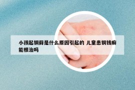 小孩起铜藓是什么原因引起的 儿童患铜钱癣能根治吗