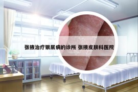 张掖治疗银屑病的诊所 张掖皮肤科医院