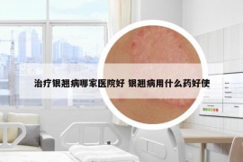 治疗银翘病哪家医院好 银翘病用什么药好使