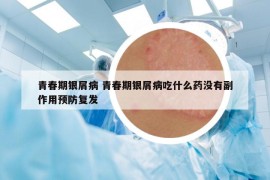 青春期银屑病 青春期银屑病吃什么药没有副作用预防复发