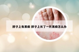 脖子上有黑癣 脖子上长了一片黑癣怎么办