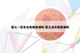 婴儿一出生会有银屑病吗 婴儿会长银屑病吗
