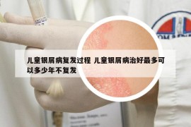 儿童银屑病复发过程 儿童银屑病治好最多可以多少年不复发