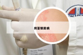 阴茎银屑病