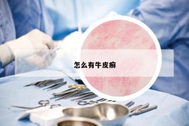 怎么有牛皮癣