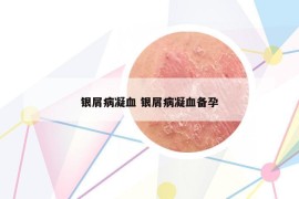银屑病凝血 银屑病凝血备孕