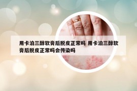 用卡泊三醇软膏后脱皮正常吗 用卡泊三醇软膏后脱皮正常吗会传染吗