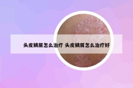 头皮鳞屑怎么治疗 头皮鳞屑怎么治疗好