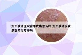 郑州肤康医院看牛皮癣怎么样 郑州肤康皮肤病医院治疗好吗