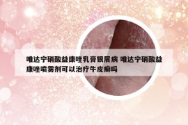 唯达宁硝酸益康唑乳膏银屑病 唯达宁硝酸益康唑喷雾剂可以治疗牛皮癣吗