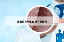 癣有没有灰色的 癣有颜色吗