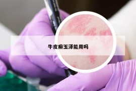 牛皮癣玉泽能用吗