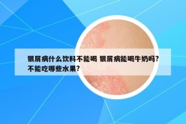 银屑病什么饮料不能喝 银屑病能喝牛奶吗?不能吃哪些水果?