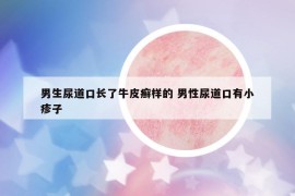 男生尿道口长了牛皮癣样的 男性尿道口有小疹子