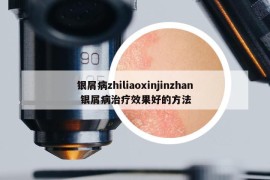 银屑病zhiliaoxinjinzhan 银屑病治疗效果好的方法