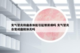 支气管炎和扁条体能引起银屑病吗 支气管炎会变成扁桃体炎吗