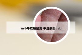 uvb牛皮癣耐受 牛皮癣照uvb