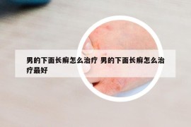 男的下面长癣怎么治疗 男的下面长癣怎么治疗最好