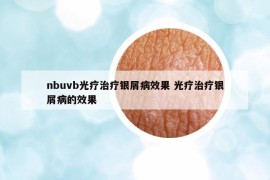 nbuvb光疗治疗银屑病效果 光疗治疗银屑病的效果