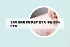 泡澡牛皮癣越来越多是严重了吗 中医泡浴治疗牛皮