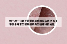 哪一项不符合寻常型银屑病的临床表现 以下不属于寻常型银屑病的典型临床特征的是