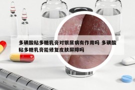 多磺酸粘多糖乳膏对银屑病有作用吗 多磺酸粘多糖乳膏能修复皮肤屏障吗