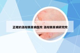 正规的洛阳银屑病医院 洛阳银屑病研究院
