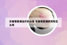 长春银屑病治疗的价格 长春银屑病研究所怎么样