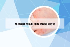 牛皮癣能洗澡吗 牛皮皮癣能自愈吗