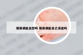 银屑病能自慰吗 银屑病能自己消退吗