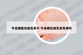 牛皮癣能吃维生素不 牛皮癣吃维生素有用吗