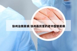 徐州治银屑病 徐州最厉害的老中医银屑病