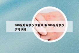 308光疗照多少次有效 照308光疗多少次可以好
