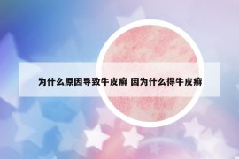 为什么原因导致牛皮癣 因为什么得牛皮癣