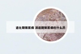 退化期银屑病 消退期银屑病吃什么药