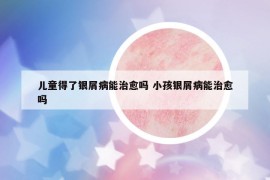 儿童得了银屑病能治愈吗 小孩银屑病能治愈吗
