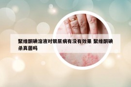 聚维酮碘溶液对银屑病有没有效果 聚维酮碘杀真菌吗
