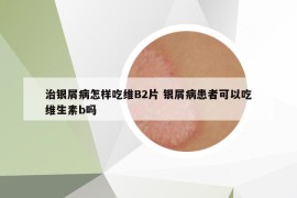 治银屑病怎样吃维B2片 银屑病患者可以吃维生素b吗