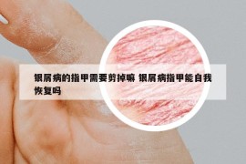 银屑病的指甲需要剪掉嘛 银屑病指甲能自我恢复吗