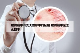 银屑病甲与先天性厚甲的区别 银屑病甲是怎么回事