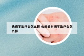 头癣不治疗会怎么样 头癣长时间不治疗会怎么样