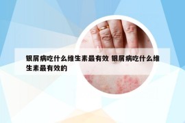 银屑病吃什么维生素最有效 银屑病吃什么维生素最有效的