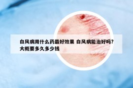 白风病用什么药最好效果 白风病能治好吗?大概要多久多少钱