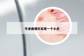 牛皮癣偶尔出现一个小点