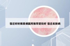 宿迁好的银屑病医院推荐楚街好 宿迁皮肤病