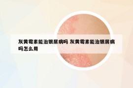 灰黄霉素能治银屑病吗 灰黄霉素能治银屑病吗怎么用